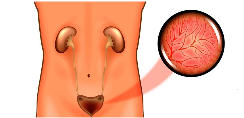 Cistitis en síntomas y tratamiento para hombres