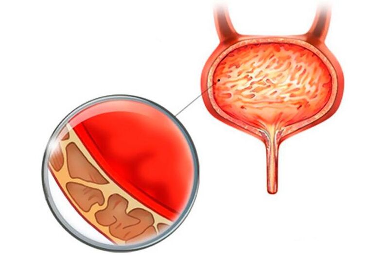 Inflamación de la membrana mucosa de la vejiga con cistitis